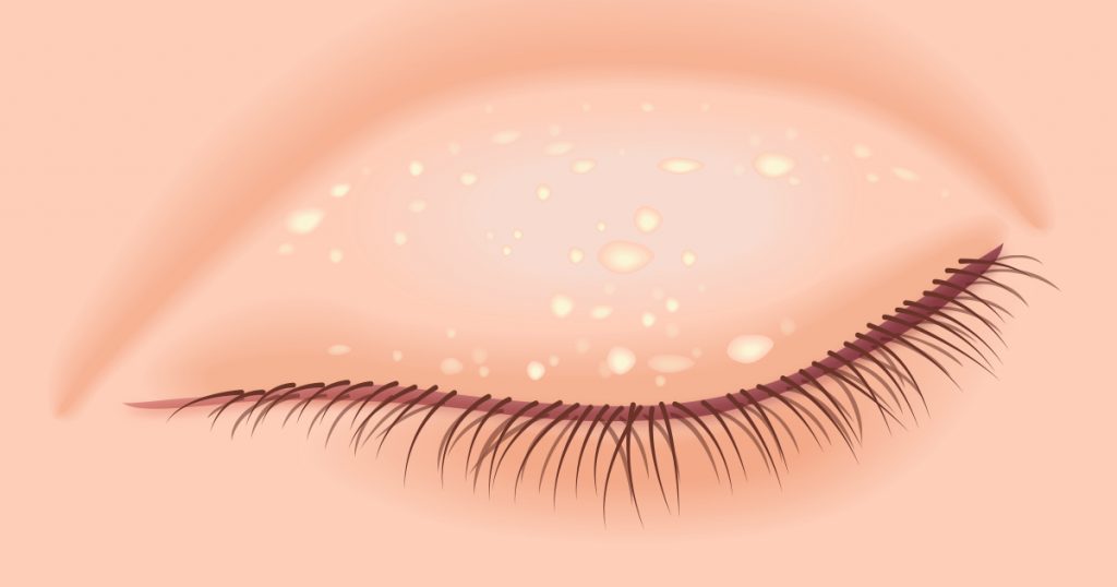 What Are Milia—and How Do You Get Rid of Them? Dermatology Blog
